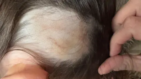 Supplied A three-year-old girl sits on a grey seat, revealing a 10cm square bald patch on her scalp, surrounded by her natural brown hair. The skin is bruised and red.