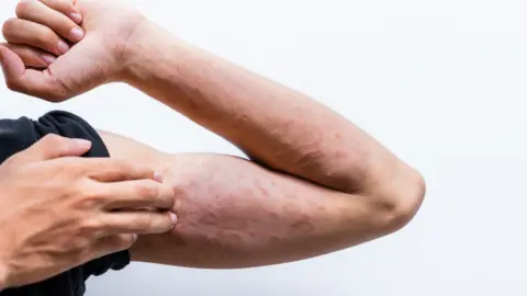 Getty A person touching their flexed arm, which has raised bumps over it
