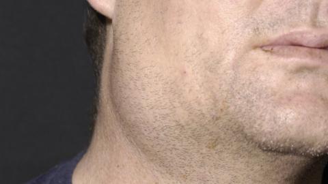 Mumps and measles cases in England prompt vaccine call - BBC News
