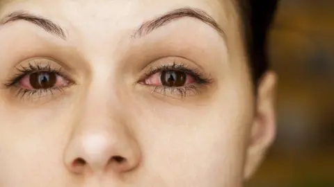 Getty Images woman with conjunctivitis