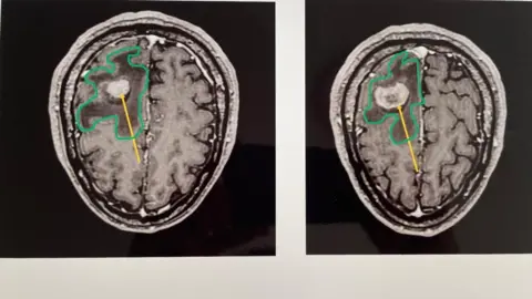 Spike Elliott Two scans of Spike's brain, side by side. One shows a larger tumour, before treatment started. The other shows a smaller tumour, after treatment.