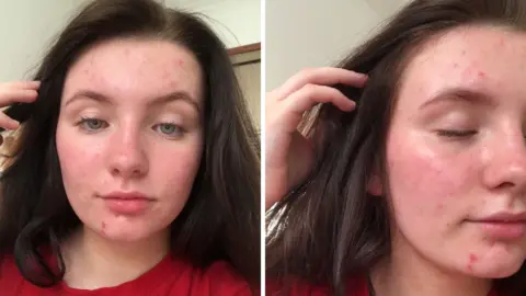 Isabel Thomas Isabel Thomas during her acne