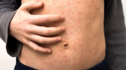 A child with a measles rash on their chest