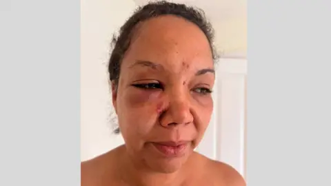 Contributed Picture of Caz with bruising and cuts to her face. She has swelling under her eyes.