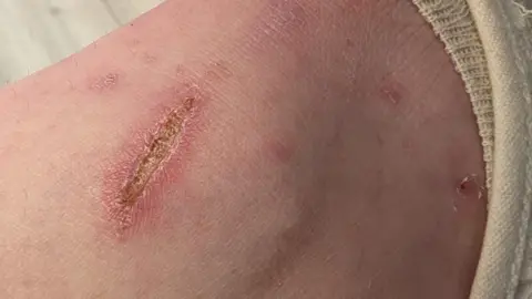 Jane Grandon A photo shows a rash on a woman's leg