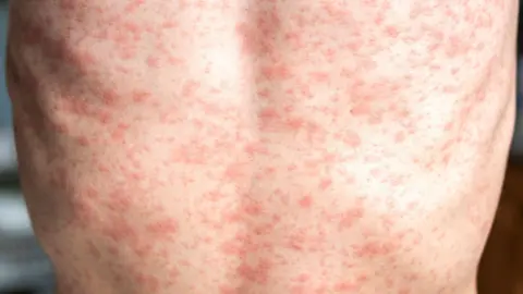 Getty Images A person's bare back is seen covered with a red measles rash
