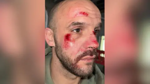 Sam Bevan Sam Bevan, a man with a short beard and shaved head is seen from a side view with bright red scrapes to his cheek, nose and forehead. The sides of the image are blurred.