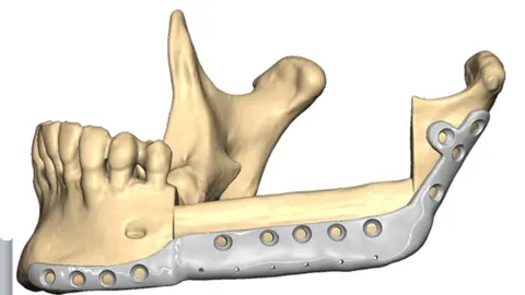 Morriston Hospital 3D printed plate
