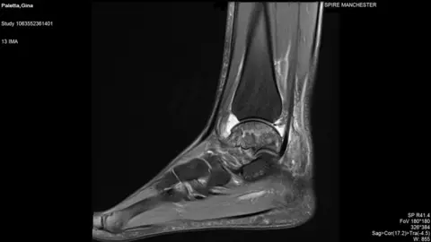 Gina Paletta An MRI of Gina's ankle in 2016 - healthy bone would show up white