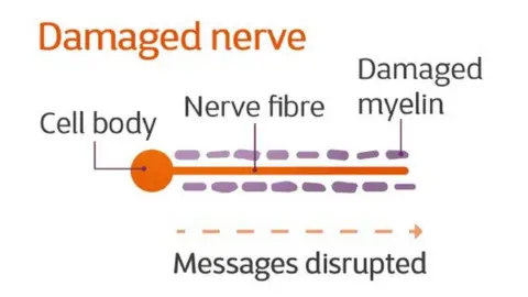 The MS Society A damaged nerve
