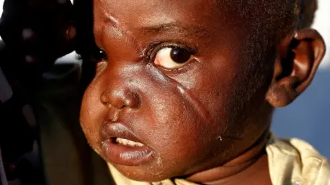 Reuters Girl with scar in a camp in Bunia, Ituri province, eastern Democratic Republic of Congo, April 9, 2018.