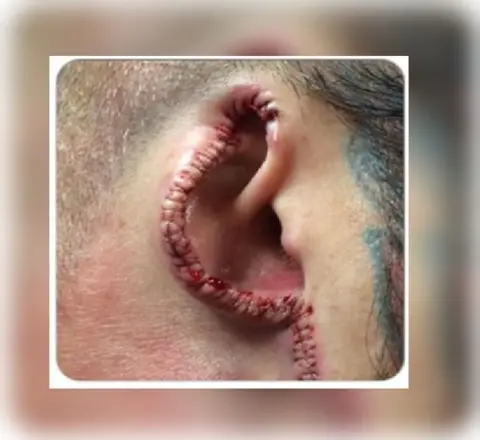 Wolverhampton City Council Ear surgery