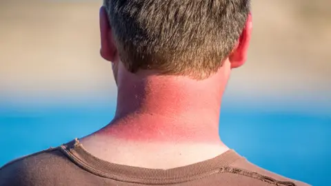 Getty Images Sunburn