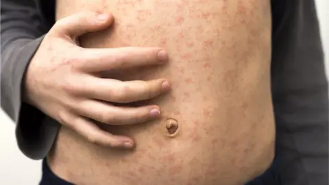 Getty Images A child with measles