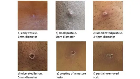 UKHSA Images showing stages of a monkeypox rash with different types of pustule.