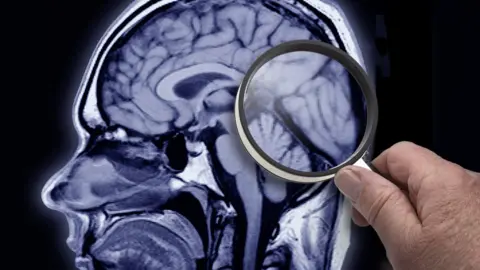 Getty Images MRI image of a head with a magnifying glass examining the brain