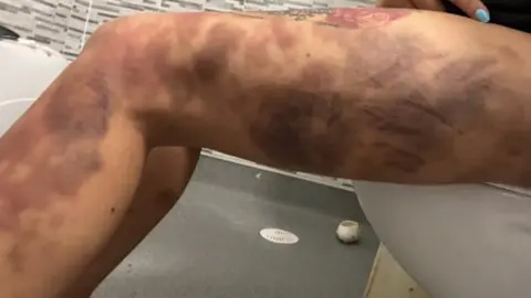 Wales news service Bruises