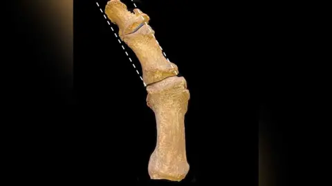 University of Cambridge Excavated medieval foot bones with bunion