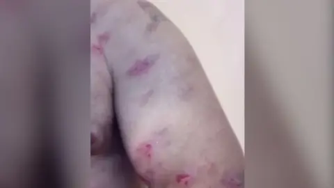 Russell Davies Spider bites on Russell Davies' arm