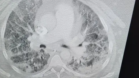 Handout Michelle's lungs after