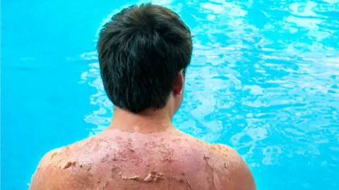 Getty Images sunburnt man