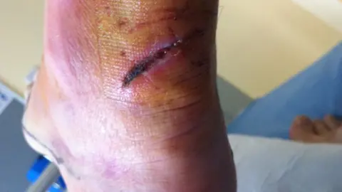 Pete Bucktrout Ankle wound