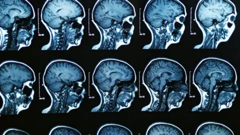 Getty Images Images from an MRI scan