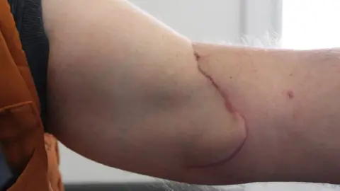GNASS A large scar on Mr Duggan's arm