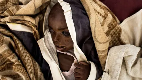 AFP/Getty severely malnourished child in Tshikapa