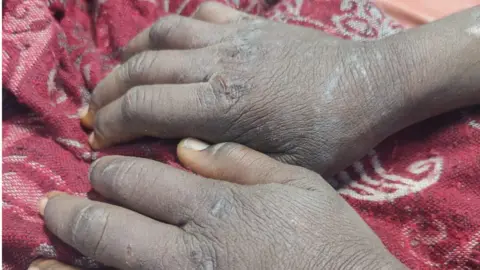 Deepika Narayan Bharadwaj The teenaged victim of torture from Gurgaon in Feb 2023 in hospital