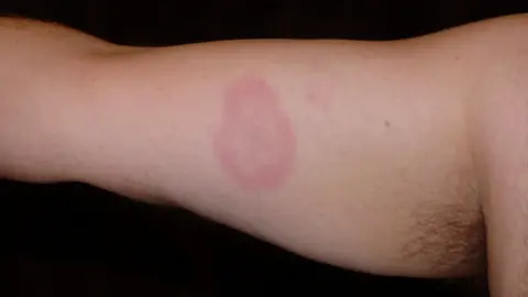 Lyme Disease Action Arm with rash