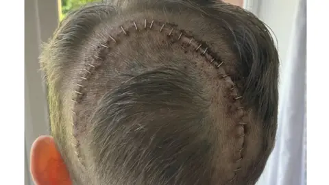 Rich Morris Stitches in Mr Morris' scalp after brain surgery