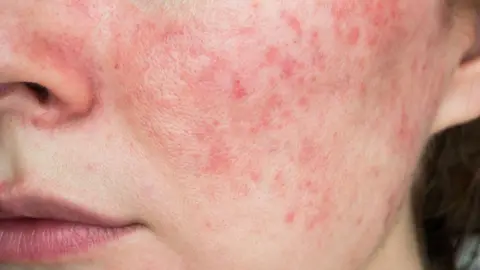 Getty Images Close up of patient's cheek