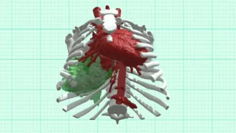 Newcastle Hospitals Trust Model of Ruby's chest