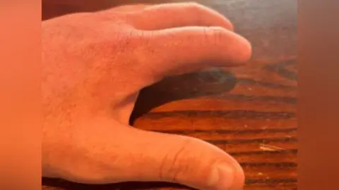 Health and Safety Executive Tom Matthews' hand after the injury