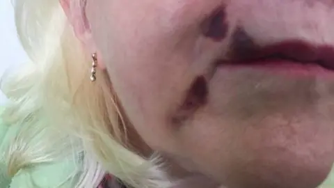 Save Face woman with bruising around lip after boot