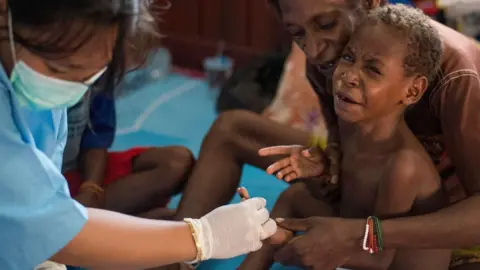 AFP/GETTY Papua, health, Indonesia, measles, malnutrition