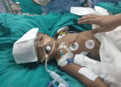 AIIMS Conjoined twin boy after surgery