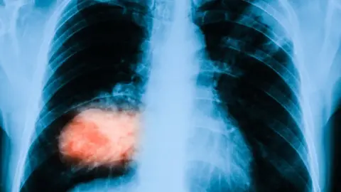 Thinkstock Chest x-ray