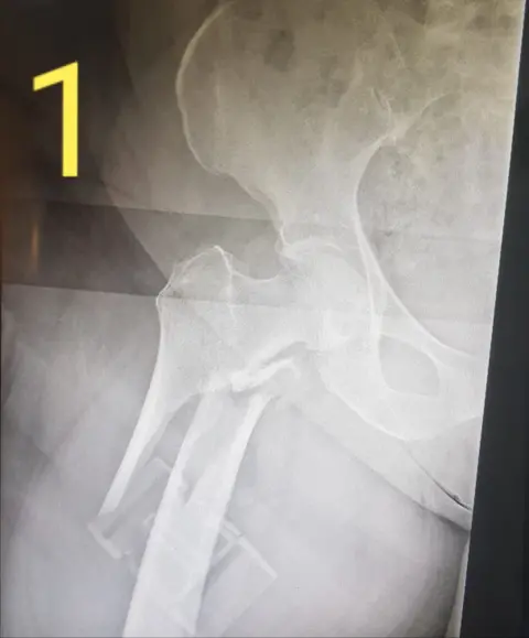 Dave Mathias An X-ray shows a hip bone snapped by the hip