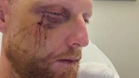 Ben Stokes recovering from facial surgery