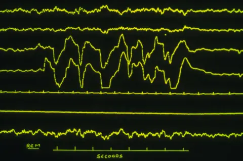 Science Photo Library EEG showing patient in REM sleep