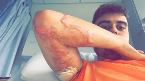 Digby Brown Jordan Mackenzie with burnt arm