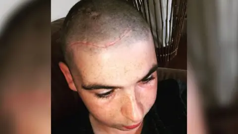 Brain Tumour Research An image taken of Liam Harvey from above, showing his shaven head and a healed pink scar stretching across his hairline, around 10cm (4ins) long.