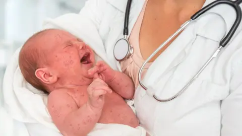 Getty Images Baby with measles (or rubella)