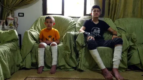 Two children with bandaged legs sits on a couch