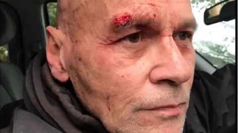 South Coast Hunt Saboteurs Simon Medhurst and his injuries