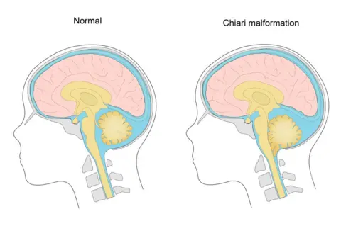 Alamy Diagram showing a Chiari Malformation