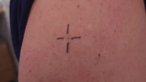 BBC Radiotherapy tattoo