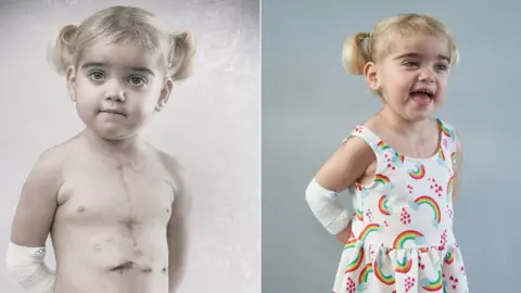 Debbie Todd Two pictures of Grace, a two-year-old girl, one with her shirt off showing her heart transplant scars and the other in a rainbow-covered dress